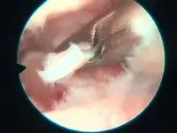 obraz podczas wykonywania astroskopii stawu kolanowego