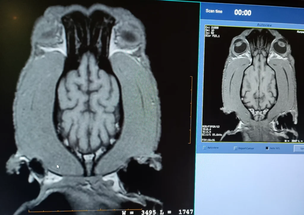 obraz prawidłowego mózgowia przy badaniu MRI