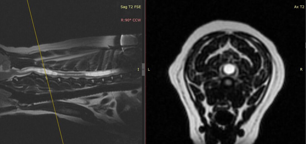 syringomyelia